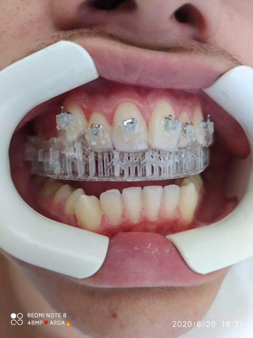 DLP SLA Senertek IBT Resin-5