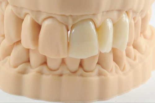 Permanent Crown Resin for DLP LCD MSLA By Purple Dance Ceramic-filled