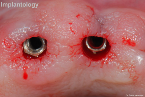 Managing Peri-implant disease using ten second technique with HYBENX Anti Biofilm Tissue Treatment Syringe 1ml 2pk - Managing Peri-implant disease using ten second technique
