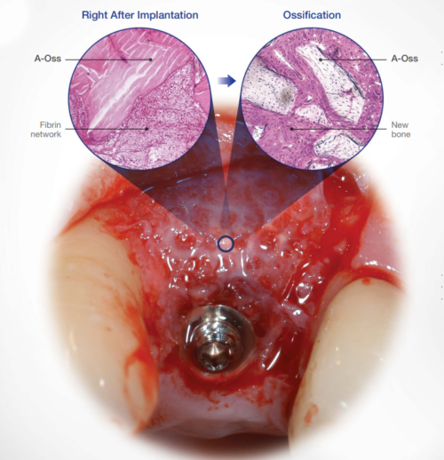 A-Oss – Xenograft Bone by Osstem Human-Like Bovine Bone Substitute